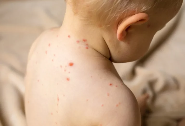 Measles Resurfaces in Montgomery County, MD, After Years of Absence